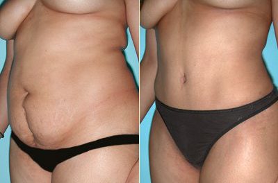 Abdominoplastia