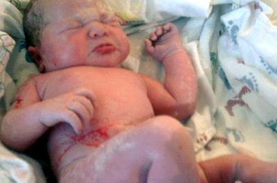 Problemas médicos en el recién nacido: Criptorquidia
