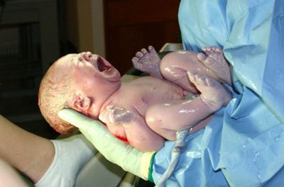 Problemas médicos en el recién nacido: Displasia de cadera