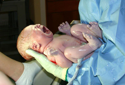Problemas médicos en el recién nacido: Displasia de cadera