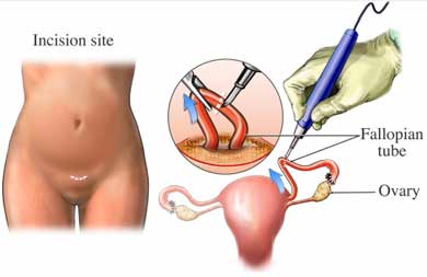 Esterilización femenina