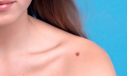 Melanoma: revisa tus lunares ¿Cómo detectarlo?