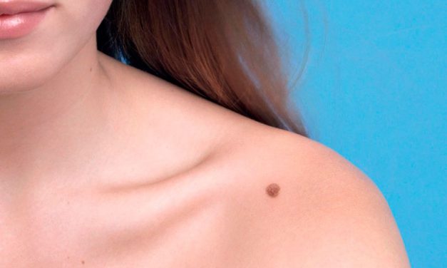 Melanoma: revisa tus lunares ¿Cómo detectarlo?