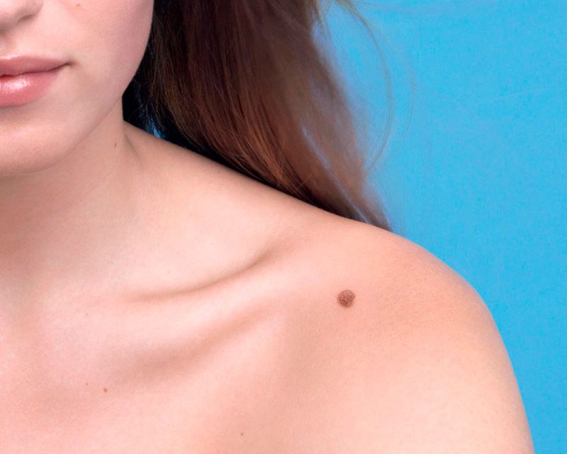 Melanoma: revisa tus lunares ¿Cómo detectarlo?