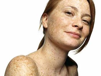 Pecas: Remedios naturales