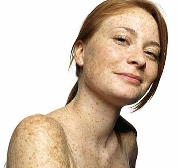 Pecas: Remedios naturales