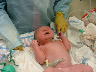 Problemas médicos en el recién nacido: Pulmón húmedo