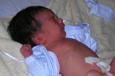 Recién nacido: Cuidados del cordón umbilical