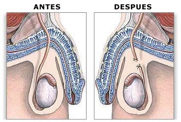 Esterilización masculina