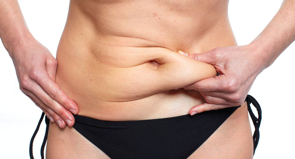 Cómo conseguir un vientre plano. Abdominoplastia, la solución definitiva a la grasa abdominal