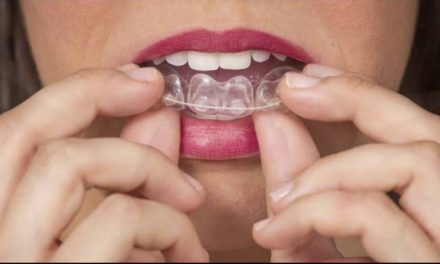 Geniova, la ortodoncia que alinea tus dientes de forma rápida, fácil e indolora
