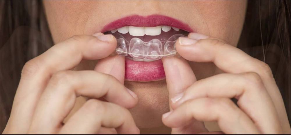 Geniova, la ortodoncia que alinea tus dientes de forma rápida, fácil e indolora