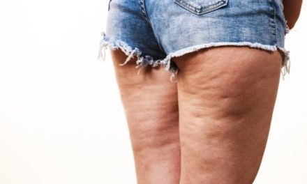 Celulitis, grasa localizada, cuales son los mejores productos