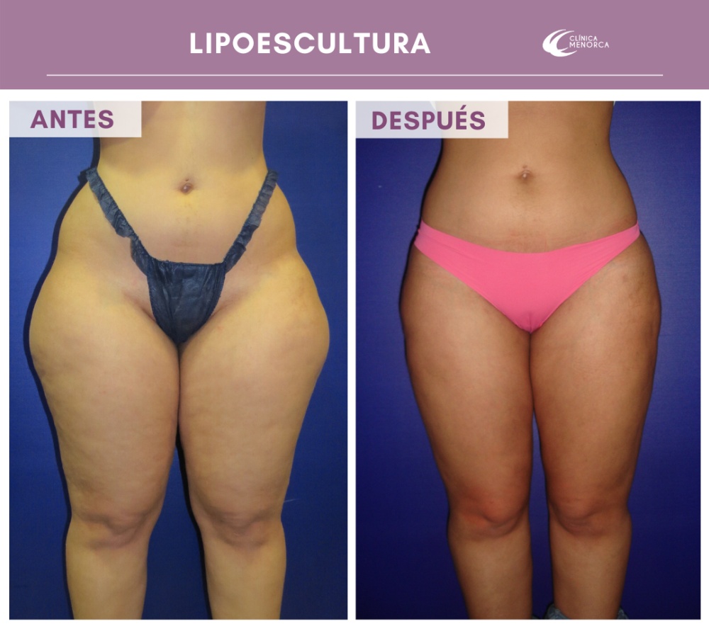 Lipoescultura de abdomen