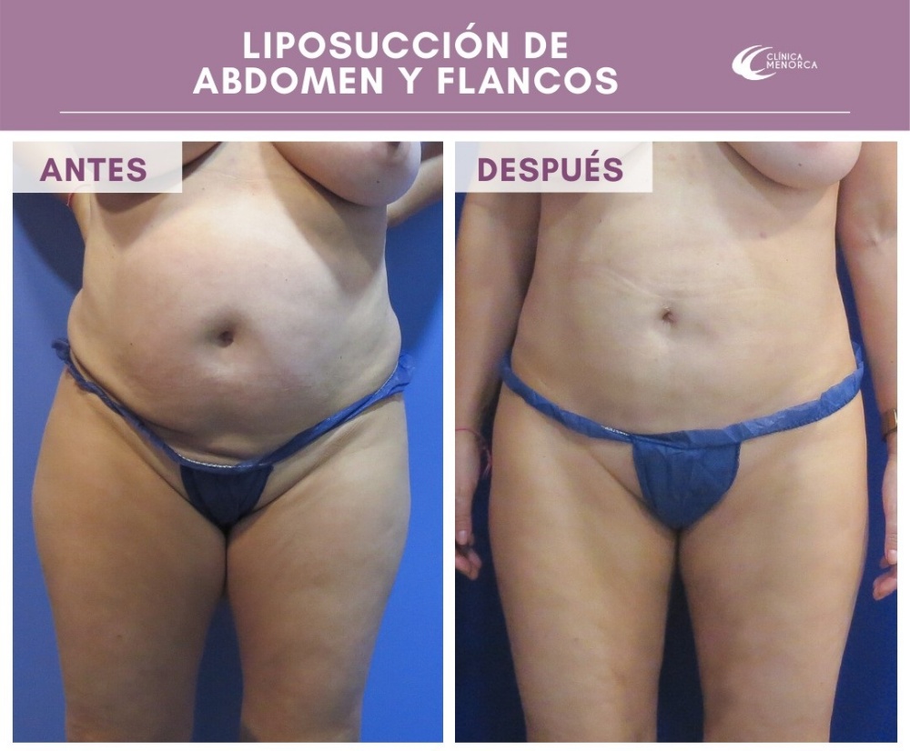 lipoescultura circunferencial