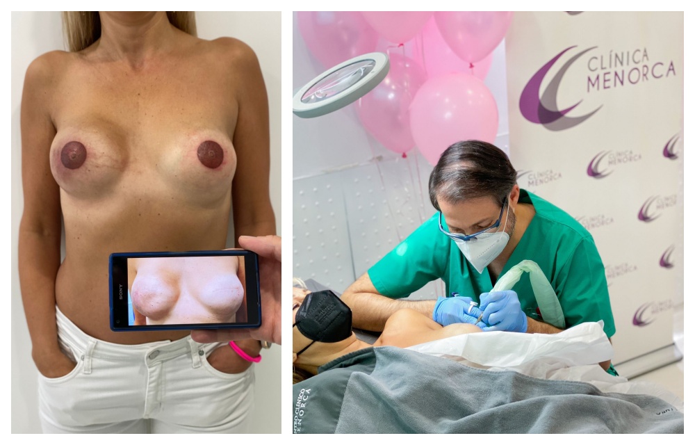 Micropigmentación de areolas mamarias