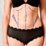 Cirugía estética: cuales son las tendencias para este verano